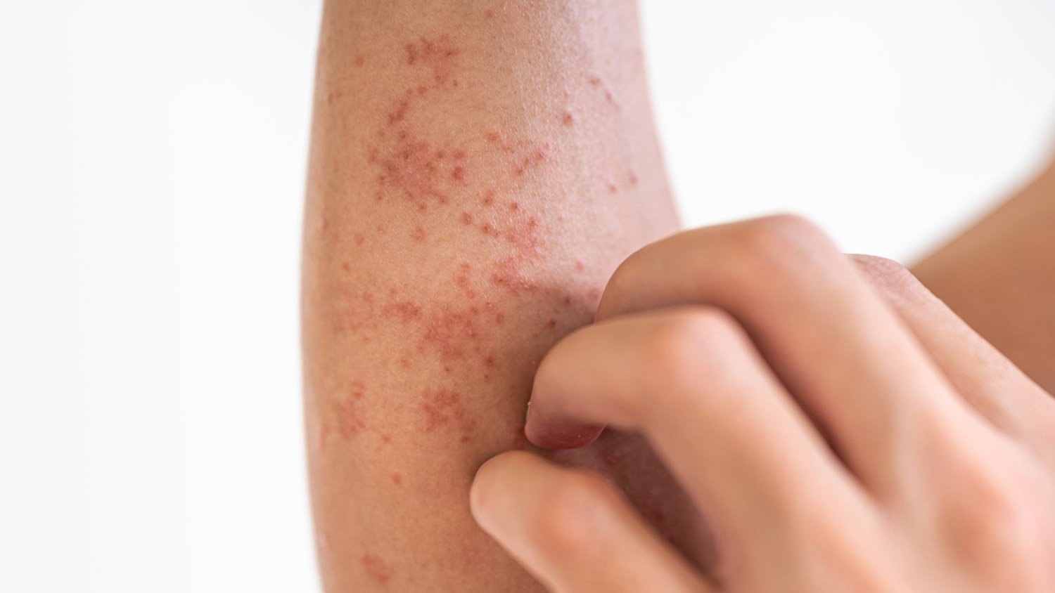 allergy