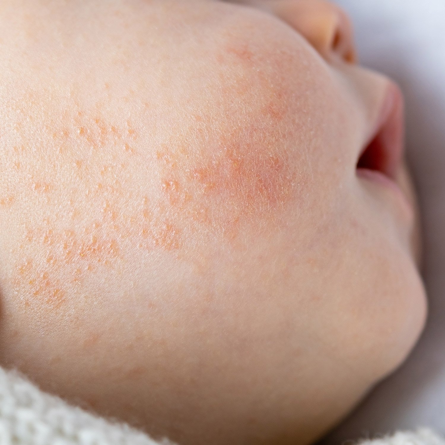 skin-treatment-1-1 skin-treatment-1-1